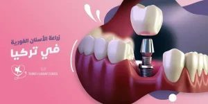 زراعة الأسنان الفورية في يس سمايل، تركيا