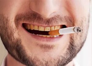 تبييض الاسنان للمدخنين مع بعض الإرشادات الهامة