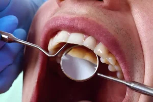 تلميع الأسنان..طرق فعالة لاستعادة ابتسامتك الطبيعية