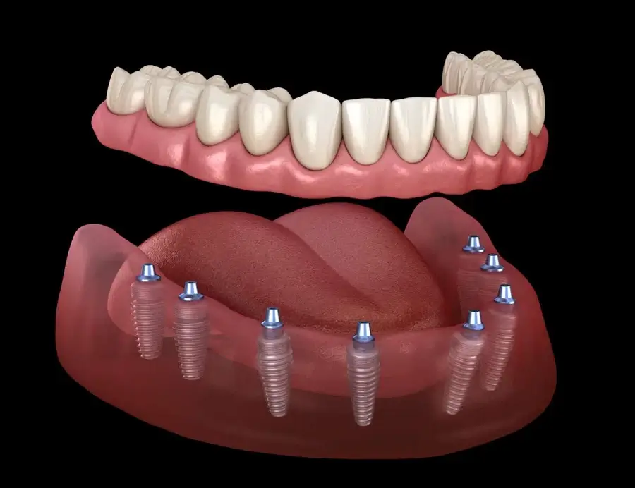 all-on-8-dental-implants