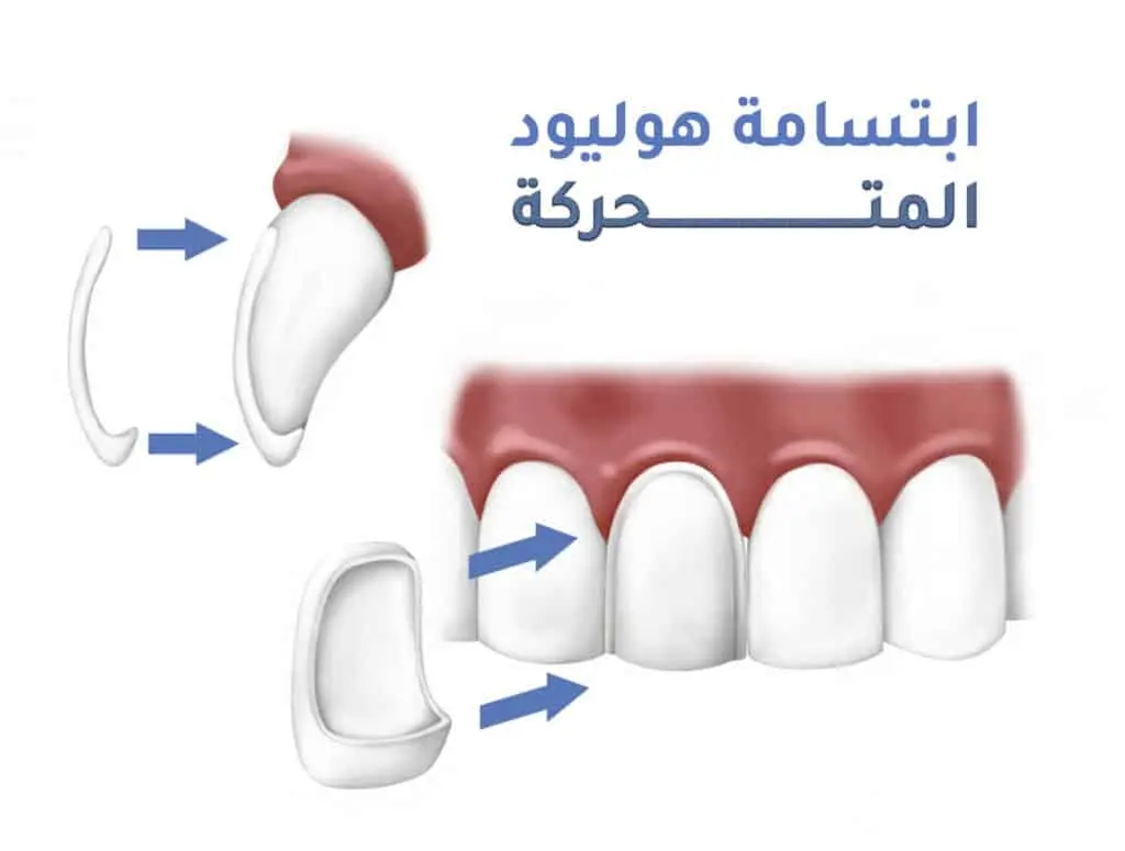 ابتسامة هوليود المتحركة | المزايا والعيوب وكيف تحافظ عليها