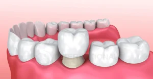 تجربتي مع تركيبات الزيركون