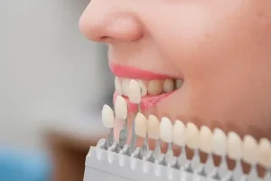 أفضل بدائل ابتسامة هوليود..التبييض أم الفينير