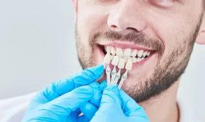 تركيب طقم أسنان فينير | كيف سيغير من شكل ابتسامتك للأبد؟