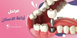 كيفية زراعة الأسنان للأطفال وطريقة إعادة زراعة السن المفقود