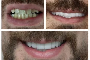 تعرف على شروط تركيب ابتسامة هوليود