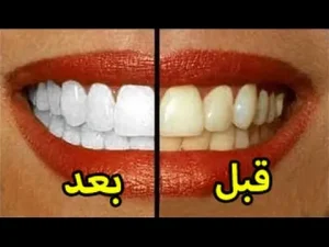 8 طرق تساعد على تبييض الأسنان بالمنزل