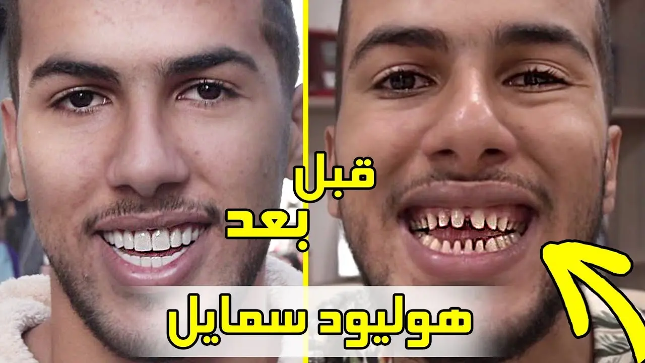 شاهد صور أسنان هوليود سمايل قبل وبعد التركيب
