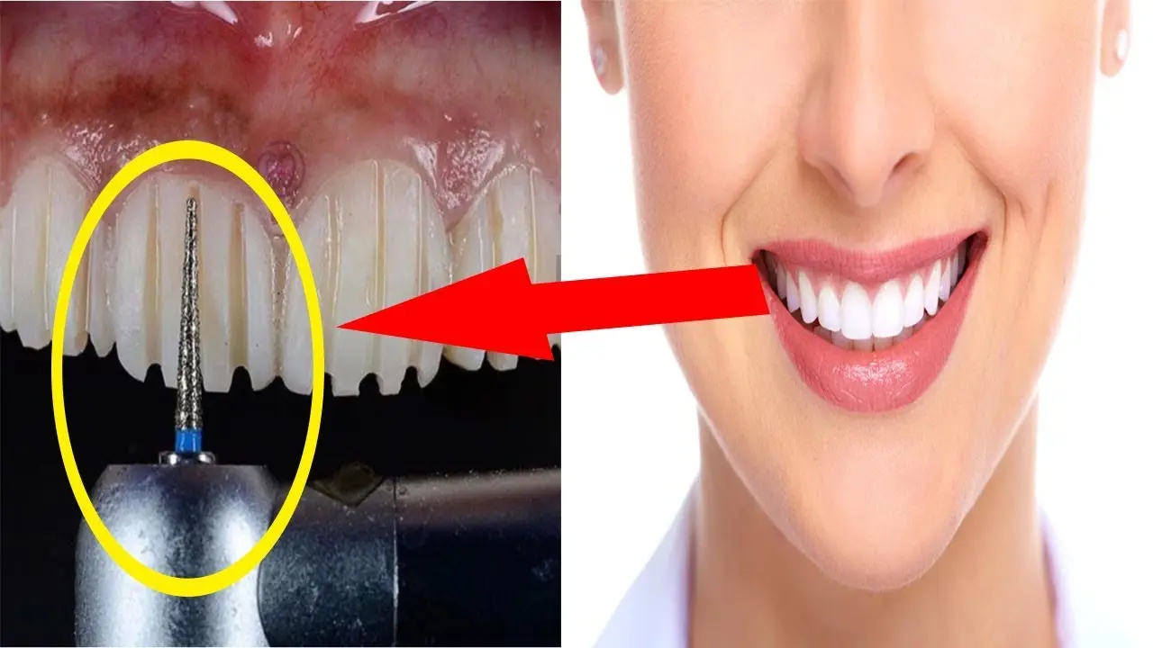 شاهد طريقة تركيب أسنان هوليود في مركز يس سمايل
