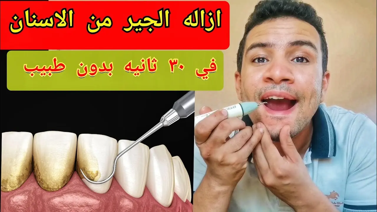 أفضل دواء لإزالة الجير من الأسنان وطرق أخرى لتنظيف الأسنان
