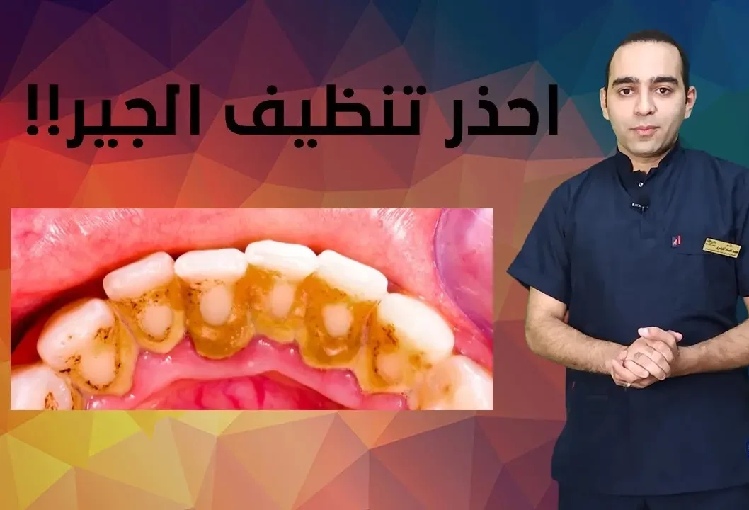 طرق تنظيف حشوة الأسنان: التنظيف في العيادة أو المنزل