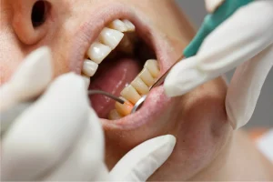 تخلخل الأسنان بعد تنظيف الجير | الأسباب وكيف تتعامل معها