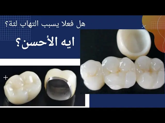 الفرق بين اسنان الزيركون والسيراميك