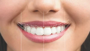 شاهد تصاميم أشكال أسنان هوليود لابتسامة مثالية