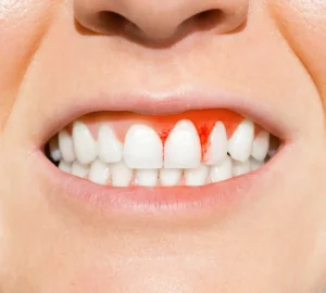 أسباب فشل زراعة الأسنان وطرق تجنبه