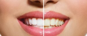 طريقة تنظيف صفار الأسنان| حل نهائي ومضمون لأجل ابتسامة واثقة