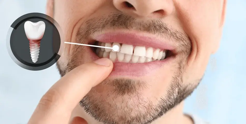 أسباب فشل زراعة الأسنان وطرق تجنبه