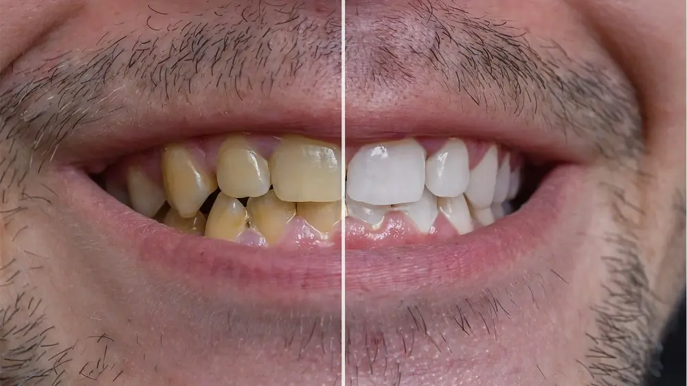 أنواع تركيبات الايماكس وطريقة اختيار النوع المناسب لابتسامتك