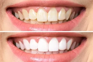 إيجابيات وسلبيات ابتسامة هوليود