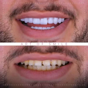 الفرق بين تلبيس الأسنان وابتسامة هوليود وأيهما الأفضل؟