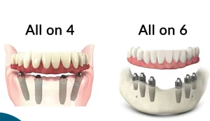 Learn about the All On 6 dental implant technology for both jaws