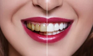 ما الفرق بين الفينير وابتسامة هوليود؟ كيف تختار ما هو مناسب لك؟