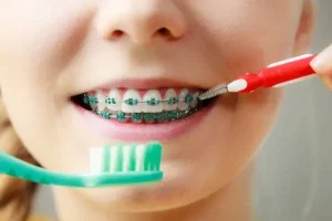 كيف أنظف أسناني بالتقويم دون إلحاق ضرر بالأقواس؟