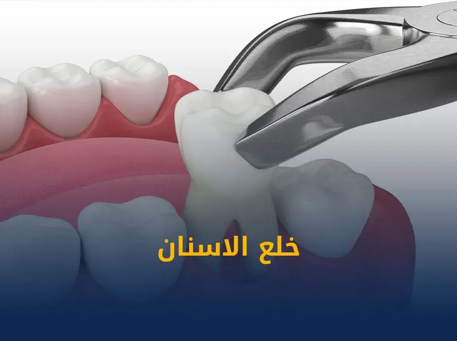 أهم 6 أسباب زراعة الأسنان وكيفية تجنب مضاعفات ما بعد العملية