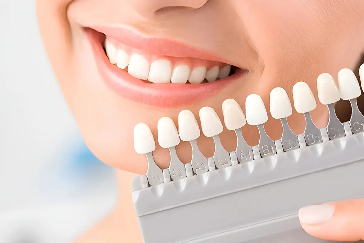 اختر لون أسنانك من بين 26 درجة من درجات ألوان ابتسامة هوليود