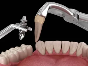 تعرف على الفرق بين زراعة الأسنان الفورية والتقليدية