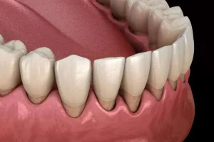 الطريقة الصحيحة لتنظيف جيوب اللثة في المنزل