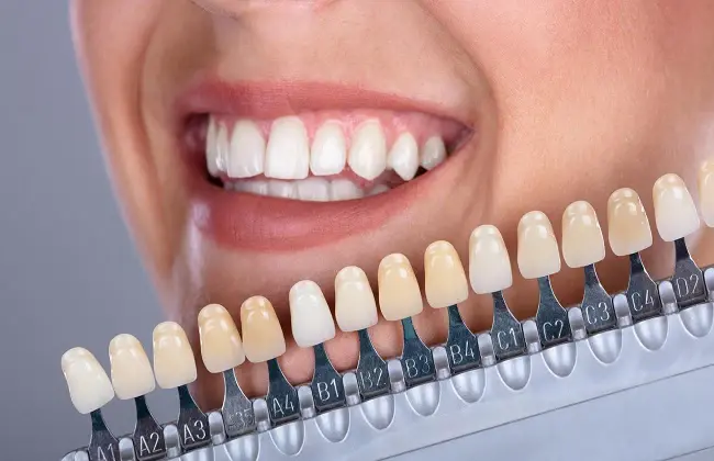درجات تبييض الأسنان الطبيعية – اختر الدرجة المناسبة لك