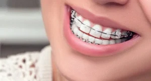 مدة تقويم الأسنان للفك المتقدم