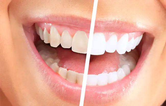 Teeth Whitening in UAE