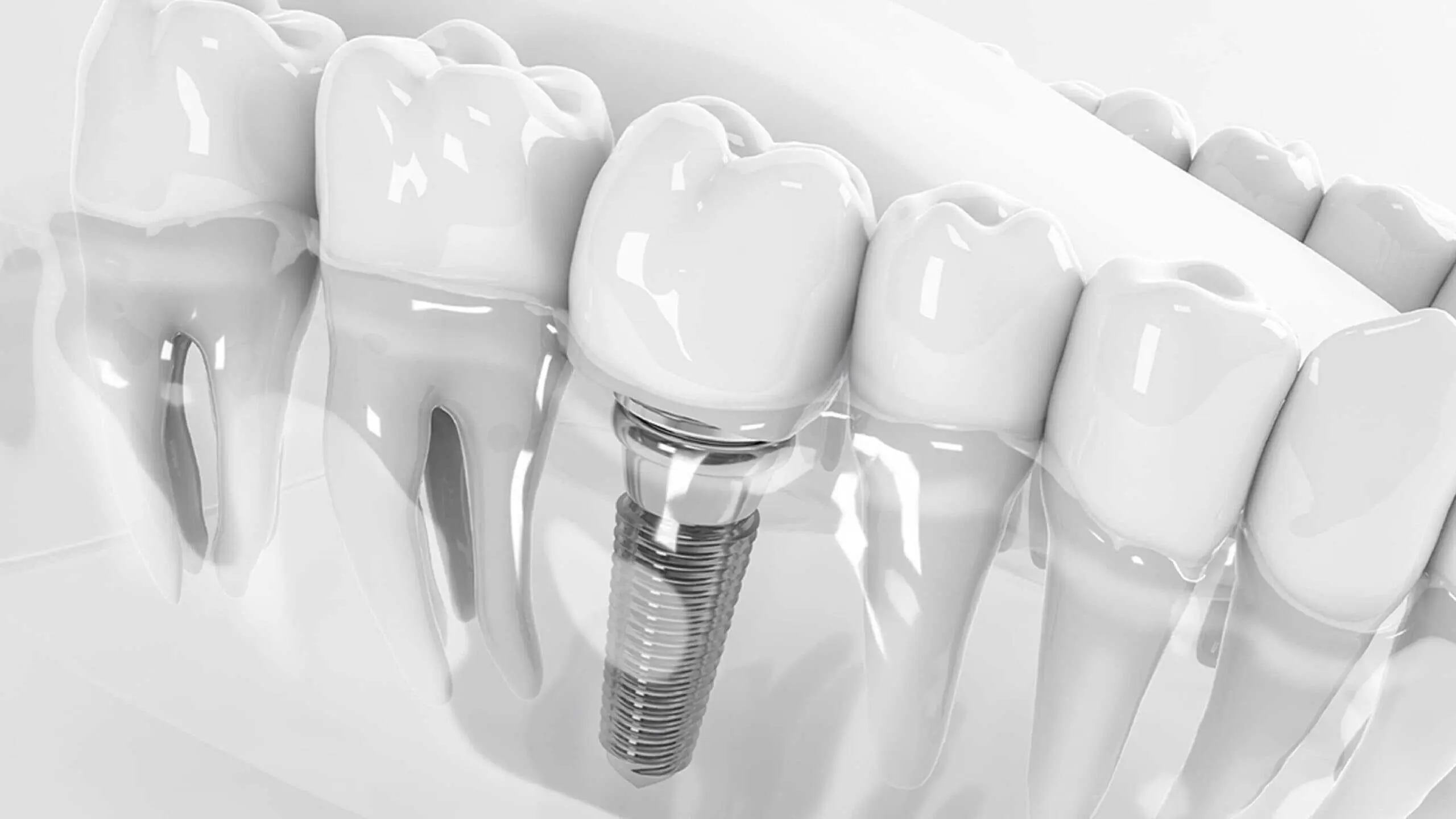 Dental Implants: The Complete Guide to Permanent Tooth Replacement in the UAE