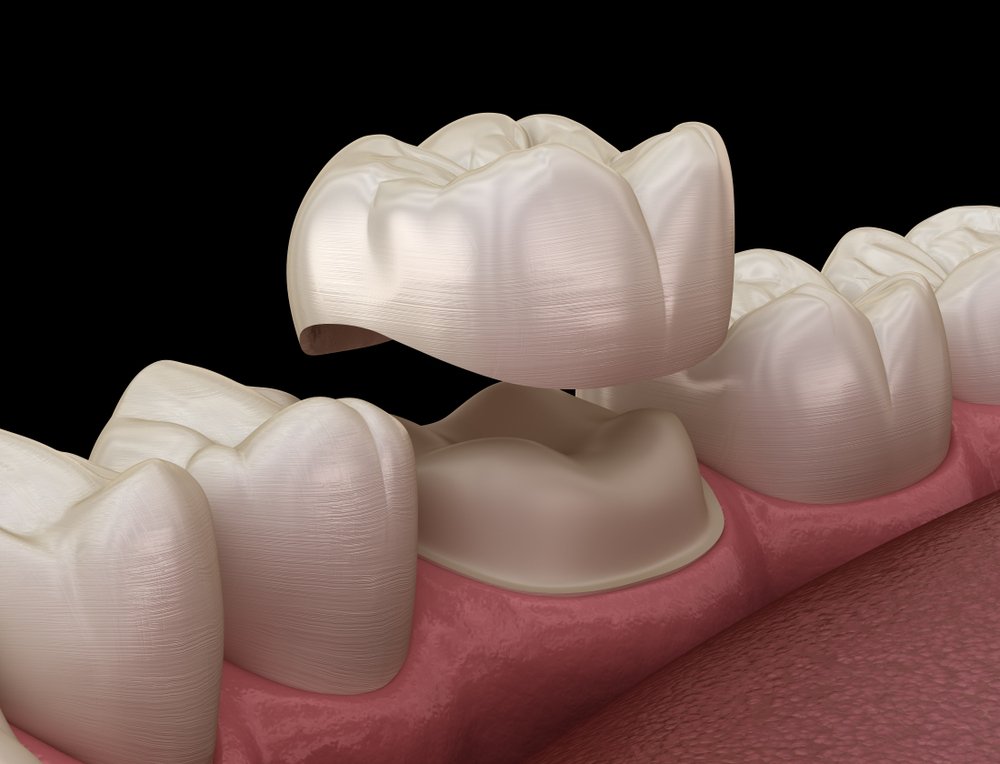 Zirconia Crowns: Complete Guide to Types, Cost & Benefits in UAE 2026